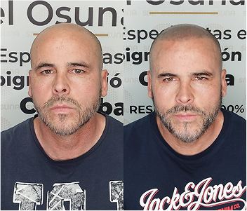 imgi 34 calvicie masculina antes despues tratamiento retrato hombre problema calvicie operacion trasplante cabello cirugia estetica proceso trasplante cabello cabeza 431724 9903