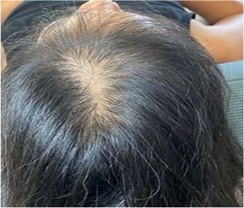 imgi 61 mujer recibiendo tratamiento perdida cabello clinica 23 2149152748
